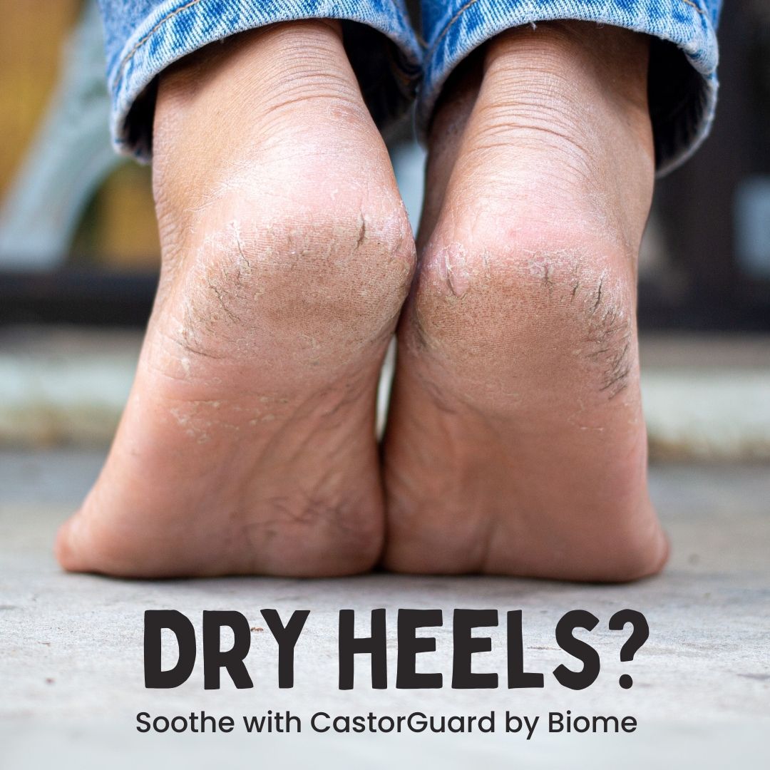 CastorGuard will moisturise dreaded dry cracked heels