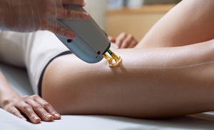 Laser-ontharing in Elsene Laser-ontharing in Elsene