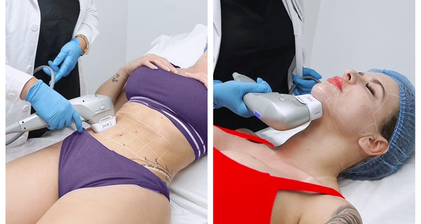 Unveil Youthful Beauty with HIFU Treatment at Cavendish Square!