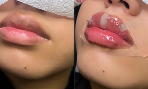 Lip Fillers