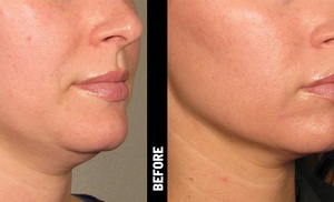 Tighten Up Your Skin with Ultherapy for Full Face or Chin + Full Neck