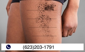Tattoo-Removal Sessions with Minimal Downtime and Discomfort