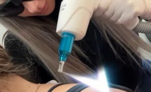 Three Laser Tattoo Removal Sessions 