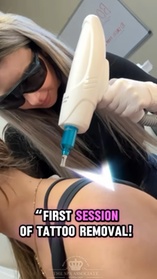 Three Laser Tattoo Removal Sessions  Three Laser Tattoo Removal Sessions