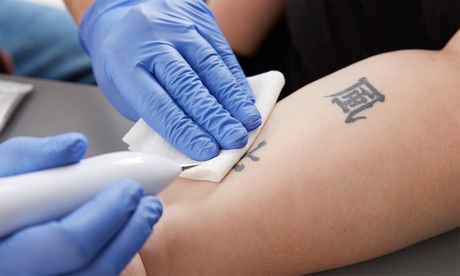 Advanced Tattoo Removal Sessions for Various Tattoo Sizes Advanced Tattoo Removal Sessions for Various Tattoo Sizes