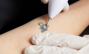 Laser Tattoo Removal with 2 Sessions for Various Sizes Laser Tattoo Removal with 2 Sessions for Various Sizes