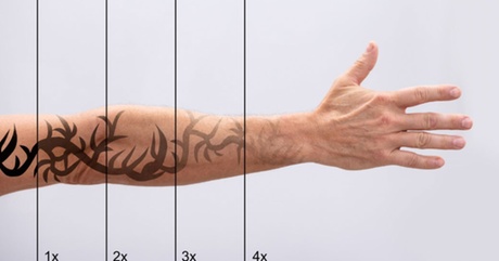 Laser Tattoo Removal Sessions on Small, Medium, or Large Areas at Advanced Health of Oakbrook – Up to 60% Off