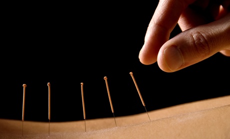 Up to 83% Off on Acupuncture Services at Trio Chiropractic and Wellness Center Up to 83% Off on Acupuncture Services at Trio Chiropractic and Wellness Center