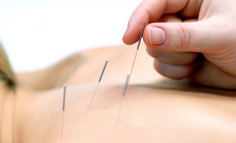 Experience Acupuncture Sessions to Relieve Pain Experience Acupuncture Sessions to Relieve Pain
