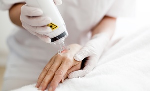 Advanced Laser Eyebrow and Large Area Tattoo Removal Sessions