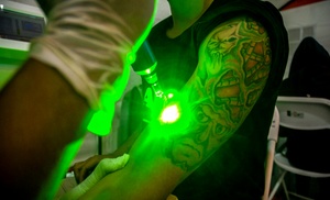 Erase Old Tattoo with One Session for Small, Medium, or Large Areas Erase Old Tattoo with One Session for Small, Medium, or Large Areas