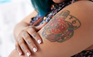 Laser Tattoo Removal for Small, Medium, or Large Areas Laser Tattoo Removal for Small, Medium, or Large Areas