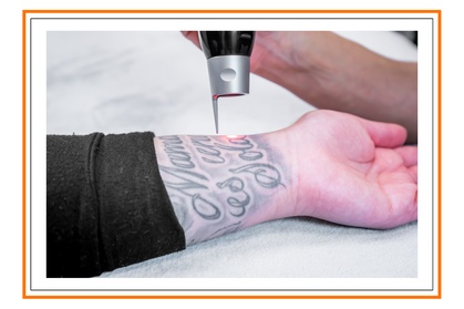 Laser Tattoo Removal Sessions for Small, Medium, or Large Areas Laser Tattoo Removal Sessions for Small, Medium, or Large Areas