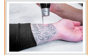 Laser Tattoo Removal Sessions for Small, Medium, or Large Areas Laser Tattoo Removal Sessions for Small, Medium, or Large Areas