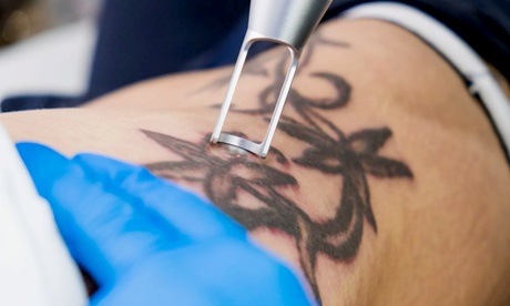 Erase That Ink: One or Three Tattoo-Removal Sessions Erase That Ink: One or Three Tattoo-Removal Sessions