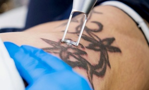 Erase That Ink: One or Three Tattoo-Removal Sessions 