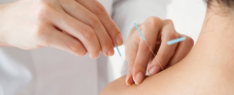 One Acupuncture session at Paul Acupuncture And Wellness