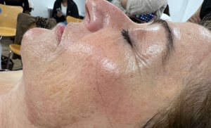 1 o 2 sesiones de exoxomas con dermapen en 2 fases en rostro completo