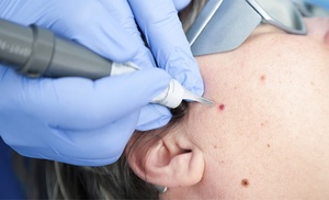 Chao imperfecciones: tratamiento de eliminación de verrugas o lunares Chao imperfecciones: tratamiento de eliminación de verrugas o lunares