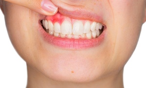 Limpieza bucal completa Limpieza bucal completa