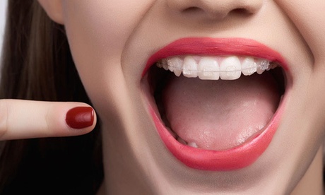 Limpieza dental y férula de descarga blanda o impresa Michigan Limpieza dental y férula de descarga blanda o impresa Michigan