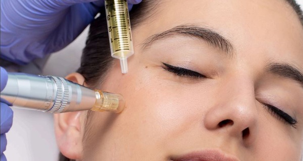 Regenera tu piel con 1 o 2 sesiones de exosomas con dermapen