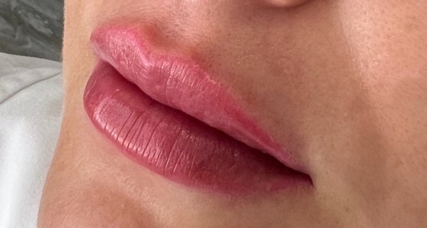 1 o 2 viales de 1.1ml de relleno dérmico en labios para 1 persona