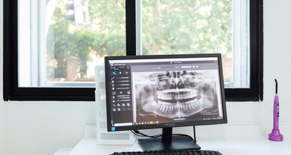 Dientes más blancos con limpieza dental y blanqueamiento en Sol Dental