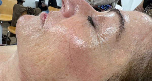 1 o 2 sesiones de exosomas con dermapen en 2 fases en rostro completo
