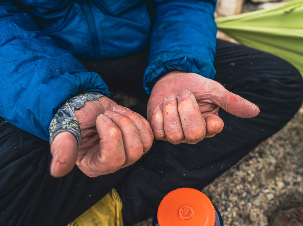 A climber inspects their swollen hands after a long route.
