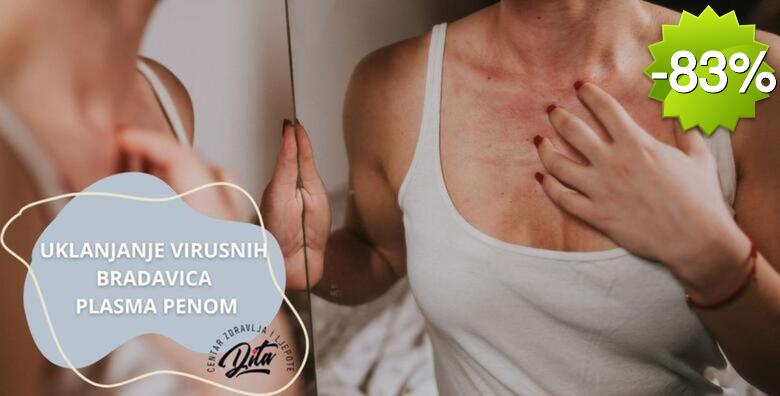 Uklanjanje neograničenog broja virusnih bradavica bezbolnim PLASMA PEN tretmanom u Centru zdravlja i ljepote Dita