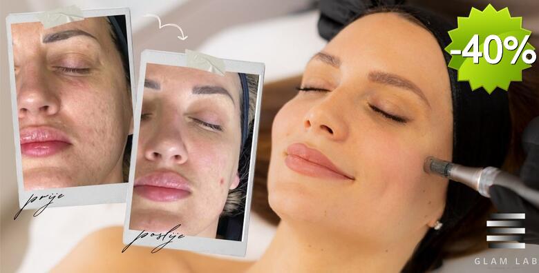 Edukacija microneedling - upoznajte se sa tehnikom regeneracije, zaglađivanja i obnavljanja kože jednodnevnom edukacijom u trajanju od 6 sati u Glam Lab-u