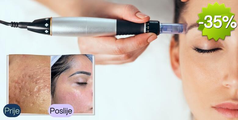 Vrhunska regeneracija kože - tretman dermapenom uz umirujuću snagu UZV špatule za sve koji žele vidljivo poboljšanje teksture, sjaja i tonusa kože u Salonu Kontesa Nera