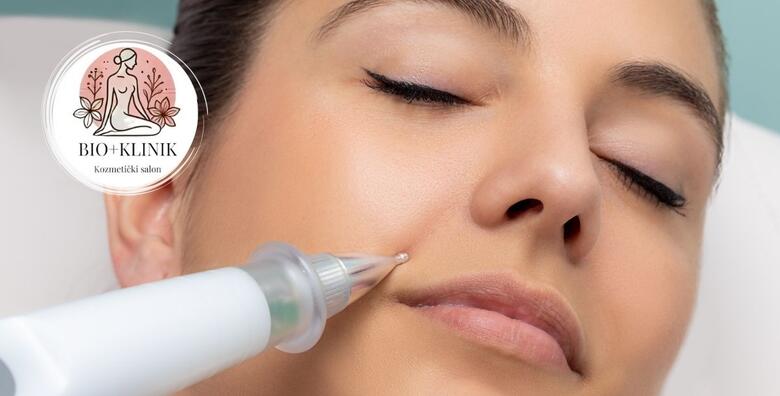 Uklanjanje bradavice, keratoze ili fibroma inovativnim tretmanom PLASMA PEN u Bio+klinik kozmetičkom salonu