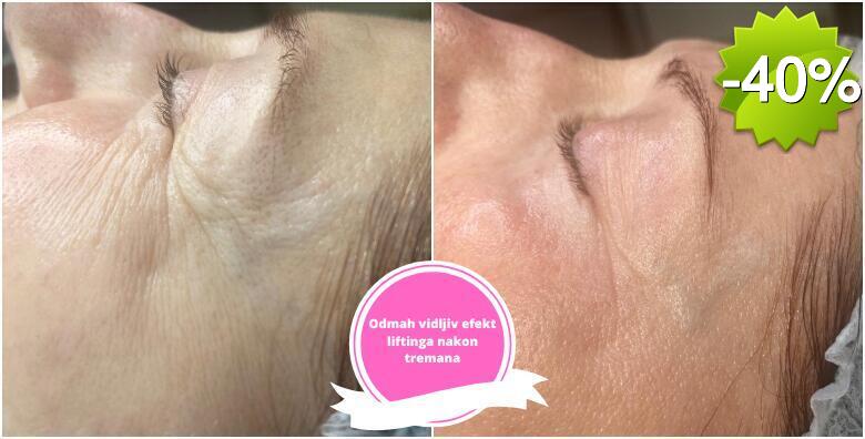 KOLAGEN NITI - potpuno prirodna i neinvazivna metoda smanjivanja bora te liftinga lica s odmah vidljivim rezultatima u Studiju ljepote Manuela