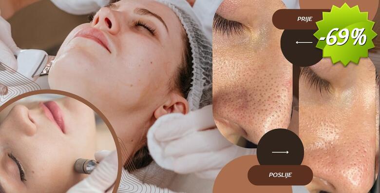 Ultrazvučno čišćenje lica špatulom uz njegu lica pilingom, maskom i masažom te dijamantna mikrodermoabrazija u Glam Lab-u