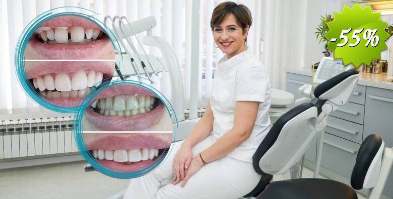 Ispravite oblik, boju, veličinu ili položaj zuba uz uveneer kompozitne ljuskice + pregled te bez skrivanja pokažite svoj novi osmijeh