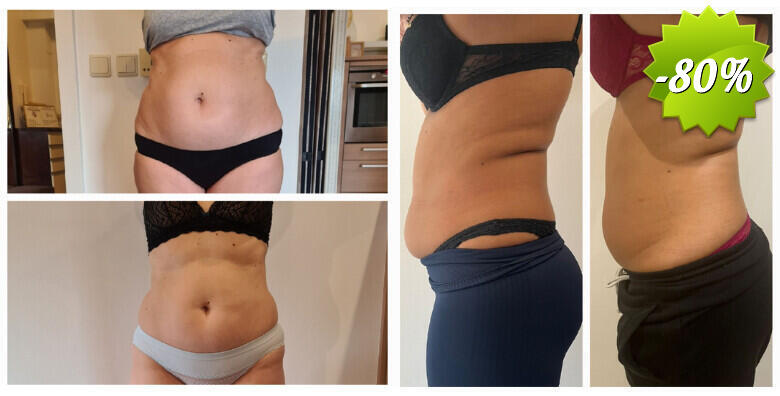 REVOLUCIJA MRŠAVLJENJA uz Green Cold Laser - za 3 tjedna do 2 konfekcijska broja manje! Brzo i sigurno smanjenje masnih naslaga uz 4 tretmana i GRATIS 2 limfne drenaže