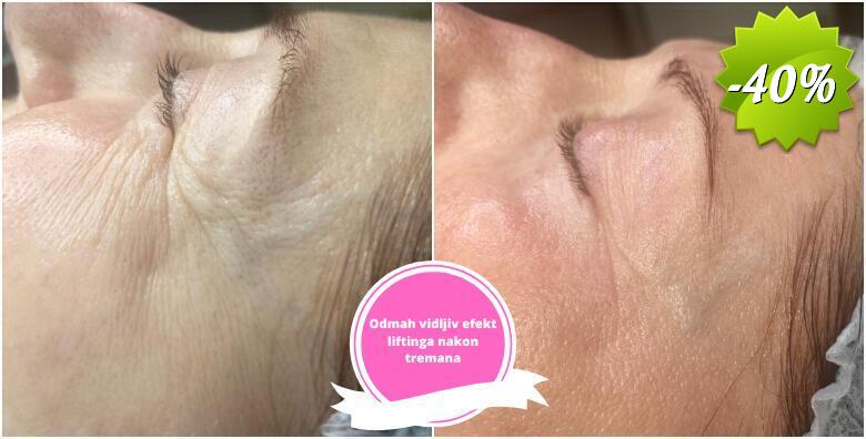 KOLAGEN NITI - potpuno prirodna i neinvazivna metoda smanjivanja bora te liftinga lica s odmah vidljivim rezultatima u Studiju ljepote Manuela