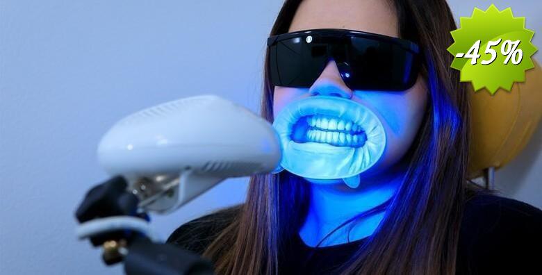 IZBJELJIVANJE ZUBI - bez oštećivanja cakline uz inovativnu Smilite LED tehnologiju i Opalescence Boost gel