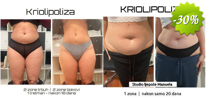 Zamrzavanje masnih stanica - CryocoolSculpting 360 ili 4D u Studiju ljepote Manuela