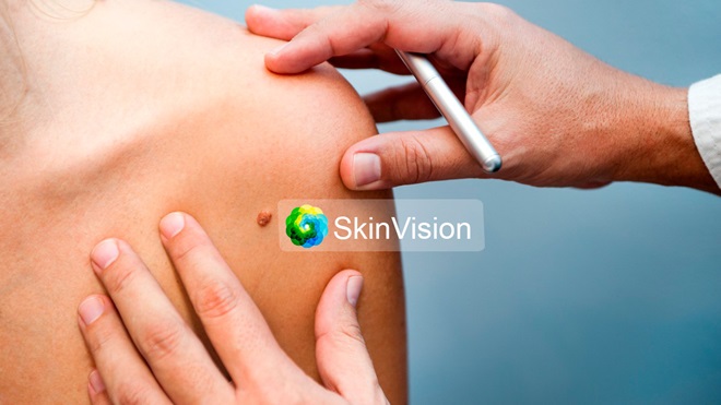 L'application SkinVision est-elle efficace et utile pour vous?