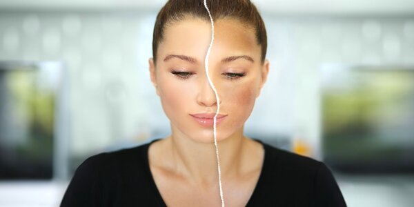 Trápia vás pigmentové škvrny? Poradíme vám, ako sa ich účinne zbaviť